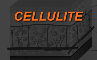 What is Cellulite and Why Do Women Get It?