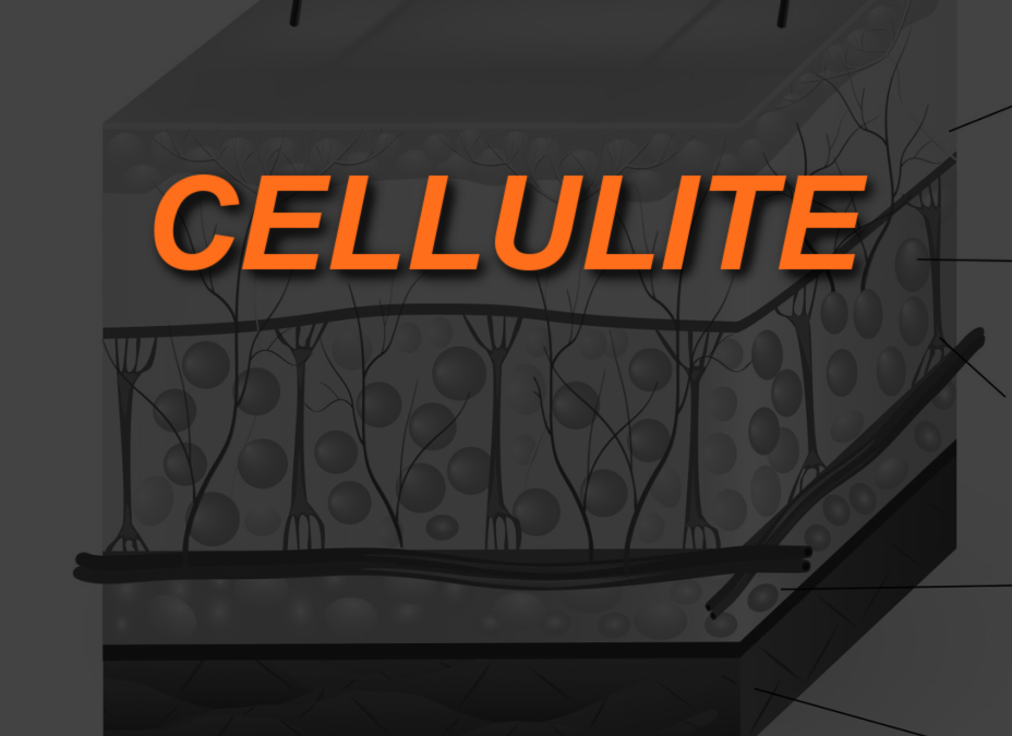 What is Cellulite and Why Do Women Get It?