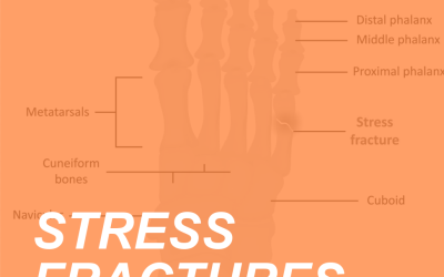 Bone up on Stress Fractures and Prevent the Pain