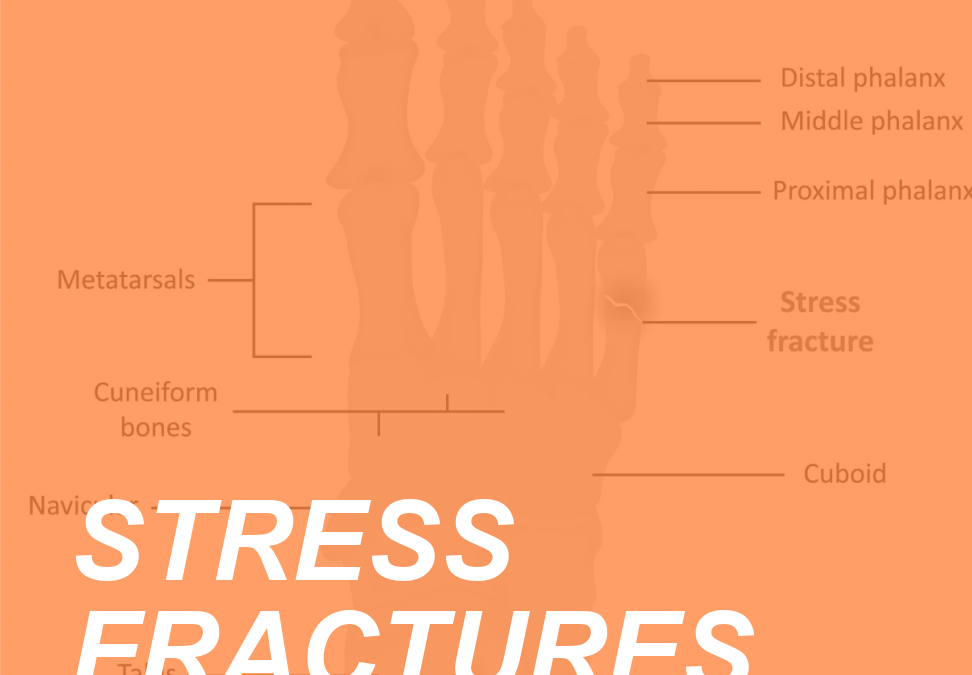 Bone up on Stress Fractures and Prevent the Pain