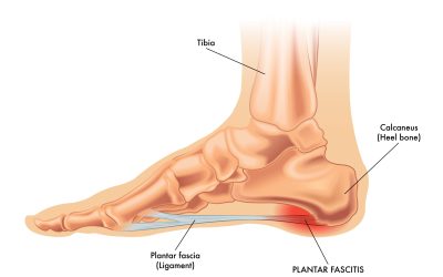 Training Clients with Plantar Fasciopathy-Related Pain